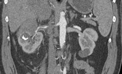 Transitional Cell Carcinoma - CTisus CT Scan