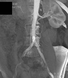 Normal Renal Arteries - CTisus CT Scan