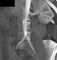 Normal Renal Arteries - CTisus CT Scan