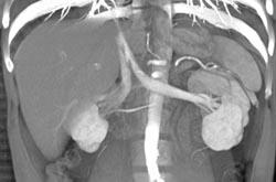 Normal Renal Veins - CTisus CT Scan