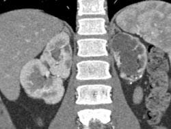 Chronic Pyelonephritis - CTisus CT Scan