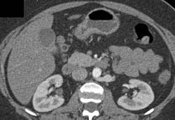 Retroaortic Renal Vein - CTisus CT Scan