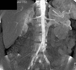 Normal Kidney - CTisus CT Scan