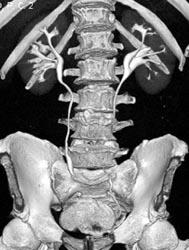 Normal CT Urogram - CTisus CT Scan