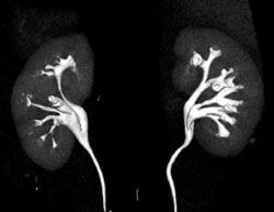 Normal CT Urogram - CTisus CT Scan