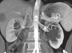 Renal Artery Anerysms - CTisus CT Scan