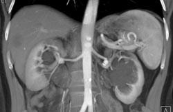 Renal Artery Aneruysms - CTisus CT Scan