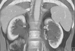 Para-pelvic Cysts - CTisus CT Scan