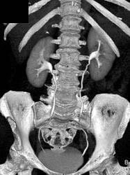 Normal CT Cystogram - CTisus CT Scan