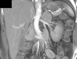 Retroaortic Left Renal Vein - CTisus CT Scan