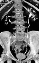 Normal CT Urogram - CTisus CT Scan