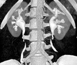 Dilated Renal Pelvises - CTisus CT Scan