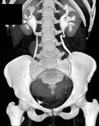 Dilated Ureters Due to Uterine Fibroids - CTisus CT Scan