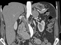 Pyelosinus Flow Right Kidney - CTisus CT Scan