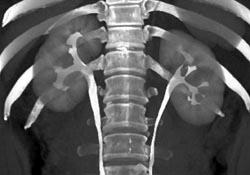 Normal CT Urogram - CTisus CT Scan