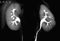 3D Mapping - Normal - CTisus CT Scan