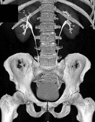 Normal CT Urogram - CTisus CT Scan