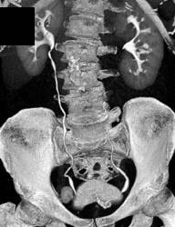 Normal Renal Pelvis - CTisus CT Scan