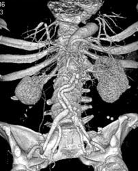 Infrarenal Aortic Aneurysm - CTisus CT Scan