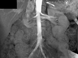 2 Left and Right Renal Arteries - CTisus CT Scan