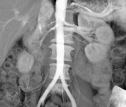 Multiple Renal Arteries - CTisus CT Scan