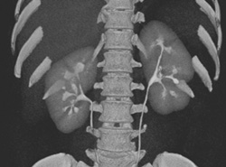 Normal CT Urogram - CTisus CT Scan