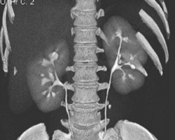 Normal CT Urogram - CTisus CT Scan