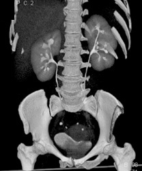 Normal Ureters - CTisus CT Scan