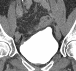 Pseudomass on Dome of Bladder - CTisus CT Scan