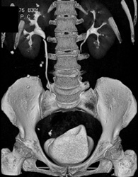 3D of Kidneys and Bladder - CTisus CT Scan