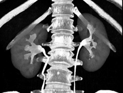 Normal CT Urogram - CTisus CT Scan