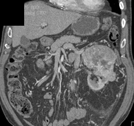 Renal Cell Carcinoma - CTisus CT Scan