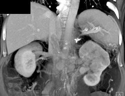 Infiltrating Renal Cell Carcinoma - CTisus CT Scan