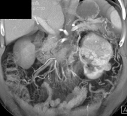 Renal Cell Carcinoma W/mesenteric Nodes - CTisus CT Scan