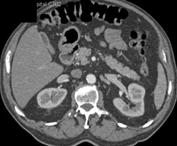 Minimal Stranding Near Right Kidney - CTisus CT Scan