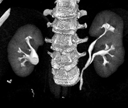 Duplicated Left Collecting System - CTisus CT Scan