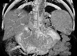 Horseshoe Kidney - CTisus CT Scan