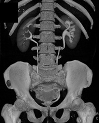 Pyelonephritis on the Left - CTisus CT Scan