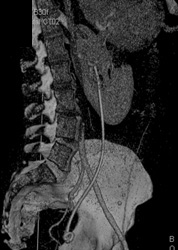 Stent in Ureter - CTisus CT Scan