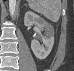 Renal Infarct - CTisus CT Scan