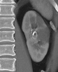 Renal Infarction - CTisus CT Scan