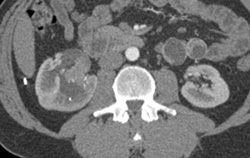 Transitional Cell Carcinoma - CTisus CT Scan