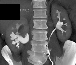 Transitional Cell Carcinoma - CTisus CT Scan