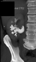 Transitional Cell Carcinoma - CTisus CT Scan