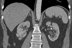 Renal Calcification - CTisus CT Scan