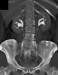 Ct Urogram - CTisus CT Scan