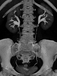 Normal CT Urogram - CTisus CT Scan