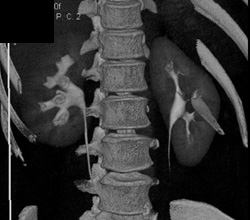 Normal Calyces - CTisus CT Scan