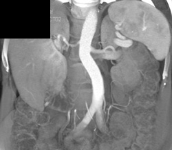 Prehilar Branching of Left Renal Artery - CTisus CT Scan