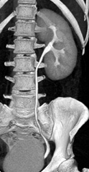 Normal Left Kidney - CTisus CT Scan